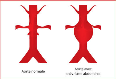 anevrisme aorte abdominal