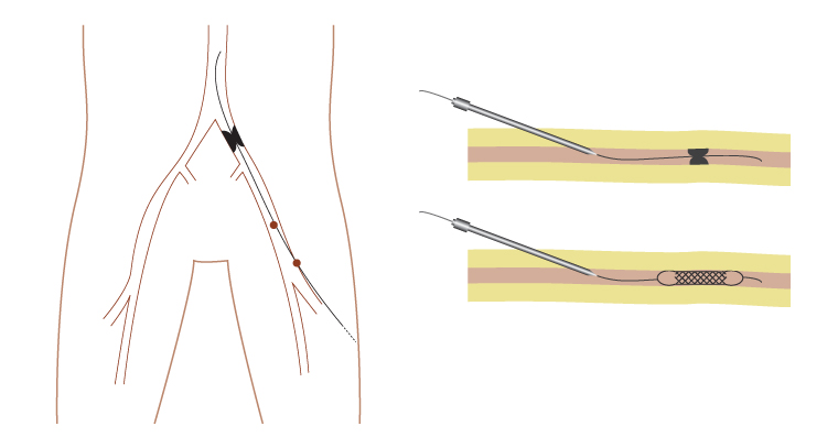 Angioplastie